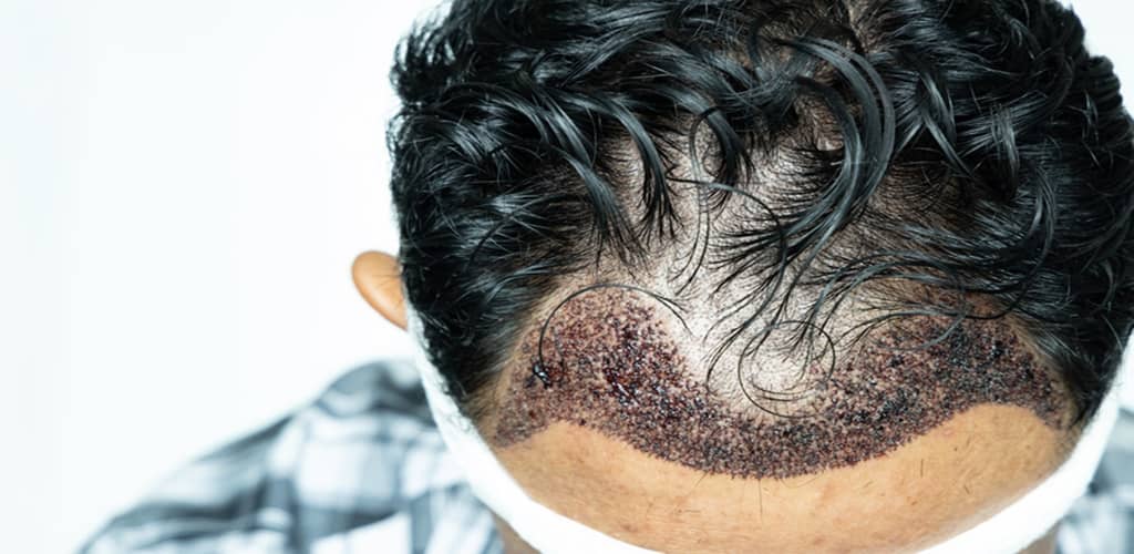 FUE Hair Transplant in Turkey Image